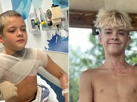 Microwaved squishy toy explodes onto boy's face and chest amid viral trend, causing horrific burns