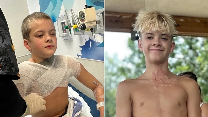 Teen at the hospital after suffering third-degree burn on chest.